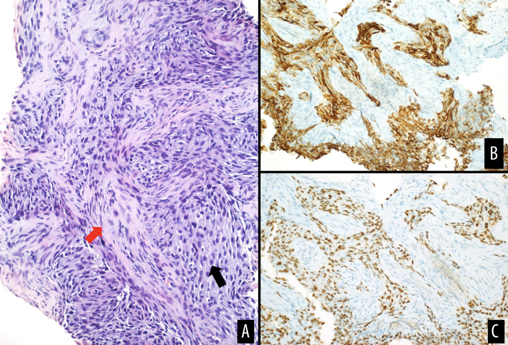 (A) Hematoxylin and eosin-stained section showing atypical spindle to epithelioid cell proliferation (black arrow) with fibrotic stroma (red arrow), consistent with adamantinoma. Immunostaining for cytokeratins 5/6 (B) and p63 (C) showing positive staining in tumor cells.