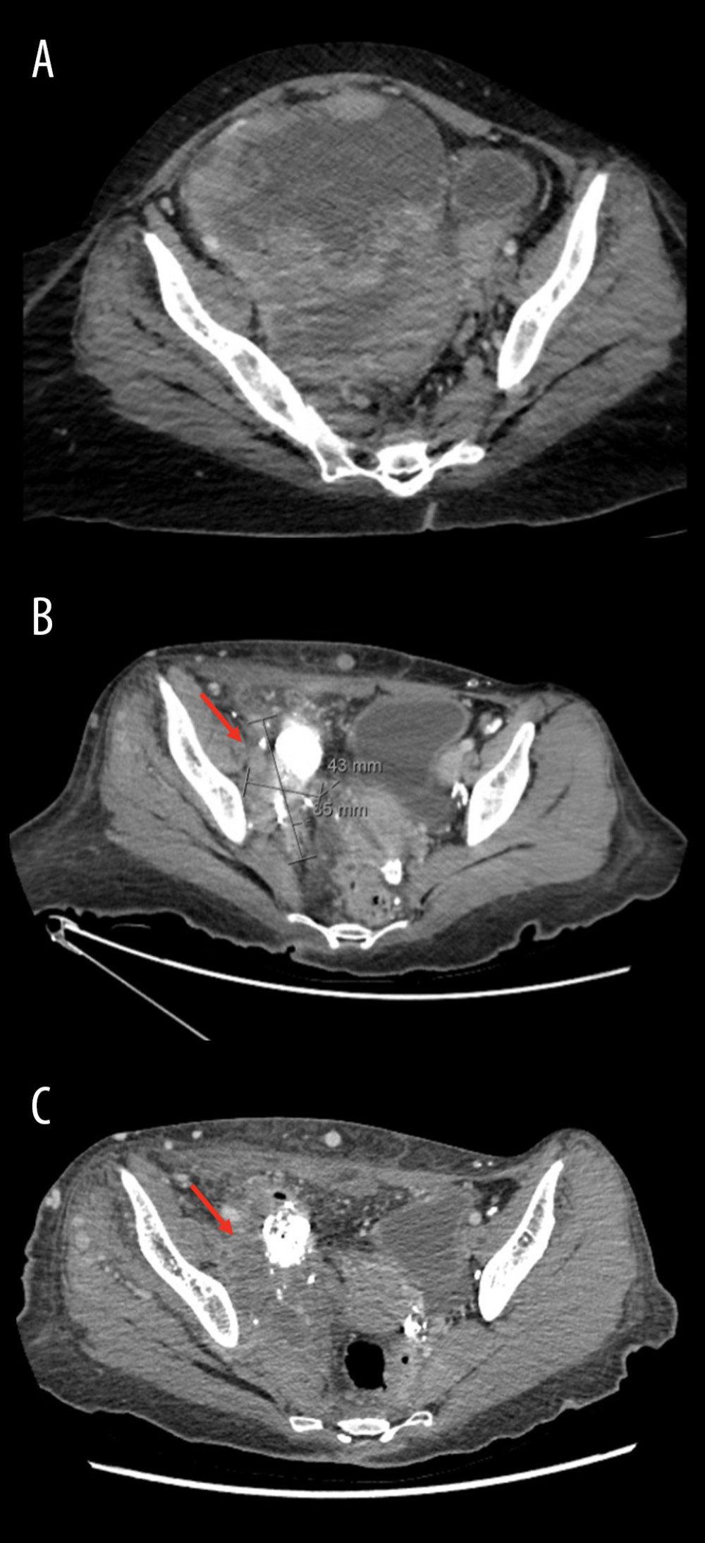 Axial computed tomography revealing a large malignant pelvic mass (arrows) before surgery at presentation (A), after surgery (B), and after pazopanib (C).