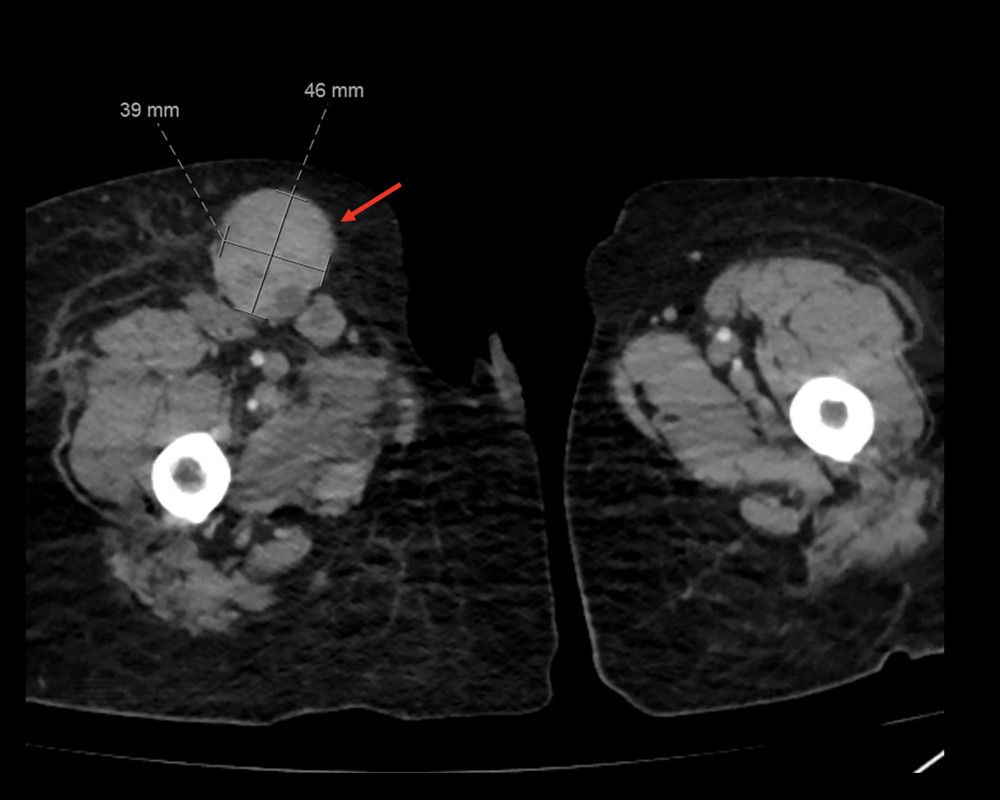 Axial computed tomography showing an enlarged inguinal lymph node measuring 46×39 mm (arrow).