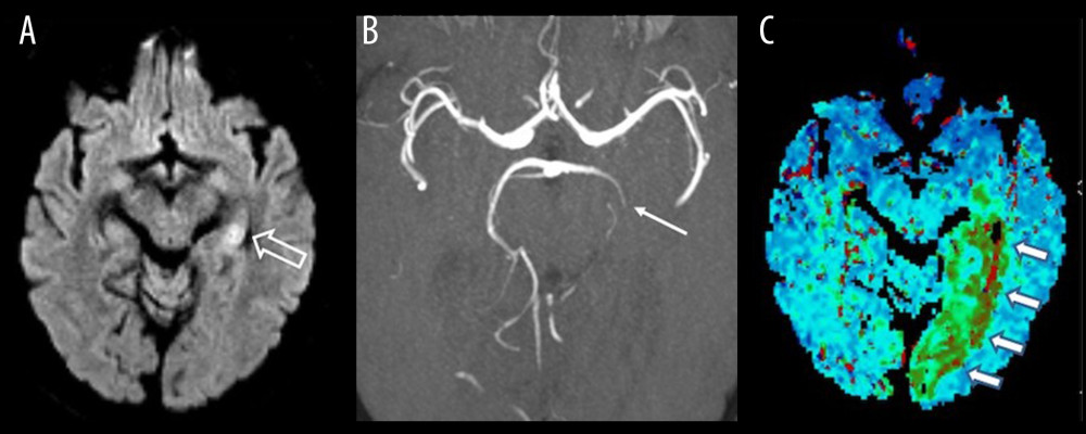 Brain Magnetic Resonance Imaging of a Patient with Left Hippocampal Acute Infarction due to an Occlusion of the Left Posterior Cerebral Artery (PCA) in the P2 segment. Axial diffusion weighted imaging with b=1000 value (A) showing left hippocampal diffusion restriction (thick arrow) consistent with acute ischemic stroke in the PCA territory. Transversal maximum intensity projection time-of-flight image showing occlusion (thin arrow) of the left PCA in the P2 segment (B) with corresponding extensive perfusion deficit (multiple arrows) in the time to peak map (C).