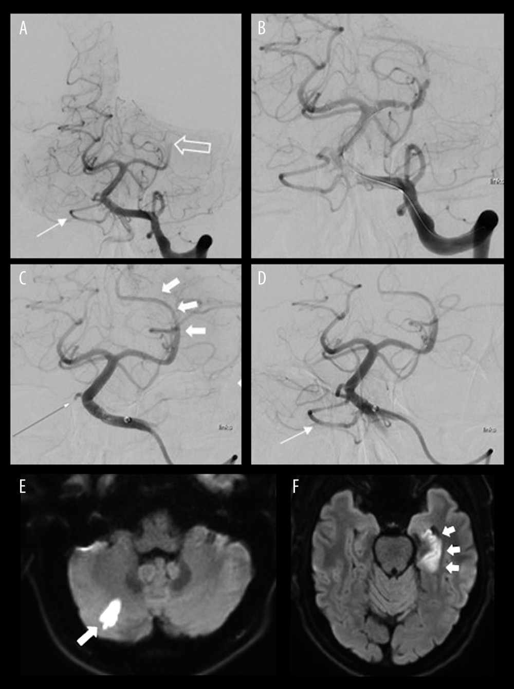 Digital Subtraction Angiography (DSA) and 24-hour control MRI in the Same Patient. DSA showing occlusion of the left posterior cerebral artery (PCA) in the P2 segment (empty arrow) with patent right posterior inferior cerebellar artery (PICA) (thin arrow) (A), with positioned stent retriever from the left P1 to the P2 segment (B). DSA showing complete recanalization of the PCA (thick arrows) and occlusion of the common origin of the right PICA and anterior inferior cerebellar artery (AICA) (thin arrow) due to partial thrombus dislocation (C). Post-procedural DSA showing complete reperfusion of the PICA and AICA (arrow) (D). 24-hour diffusion weighted imaging (DWI) showing a new subacute small cerebellar ischemia (arrow) in the right PICA territory (E) and 24-hour fluid-attenuated inversion recover (FLAIR) images showing the known left hippocampal infarction (arrows) (F).