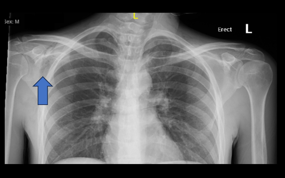 Chest X-ray of the patient with subcutaneous emphysema on physical exam indicates subcutaneous air over the right scapular region (blue arrow).