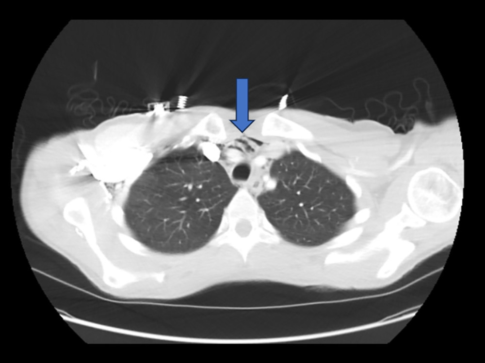 Chest CT scan of the patient, who presented with chest pain, dyspnea, and subcutaneous emphysema, demonstrates a moderate-volume pneumomediastinum tracking into the supraclavicular fossa along the right chest wall (blue arrow).