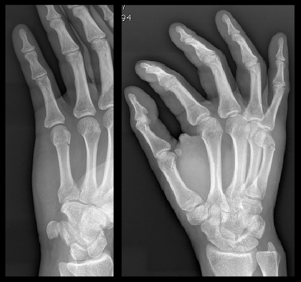 Preoperative radiographic images confirmed an angulated, displaced right fifth metacarpal neck fracture.