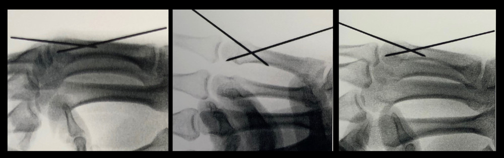 Postoperative image intensifier picture confirming good fracture alignment and stability.