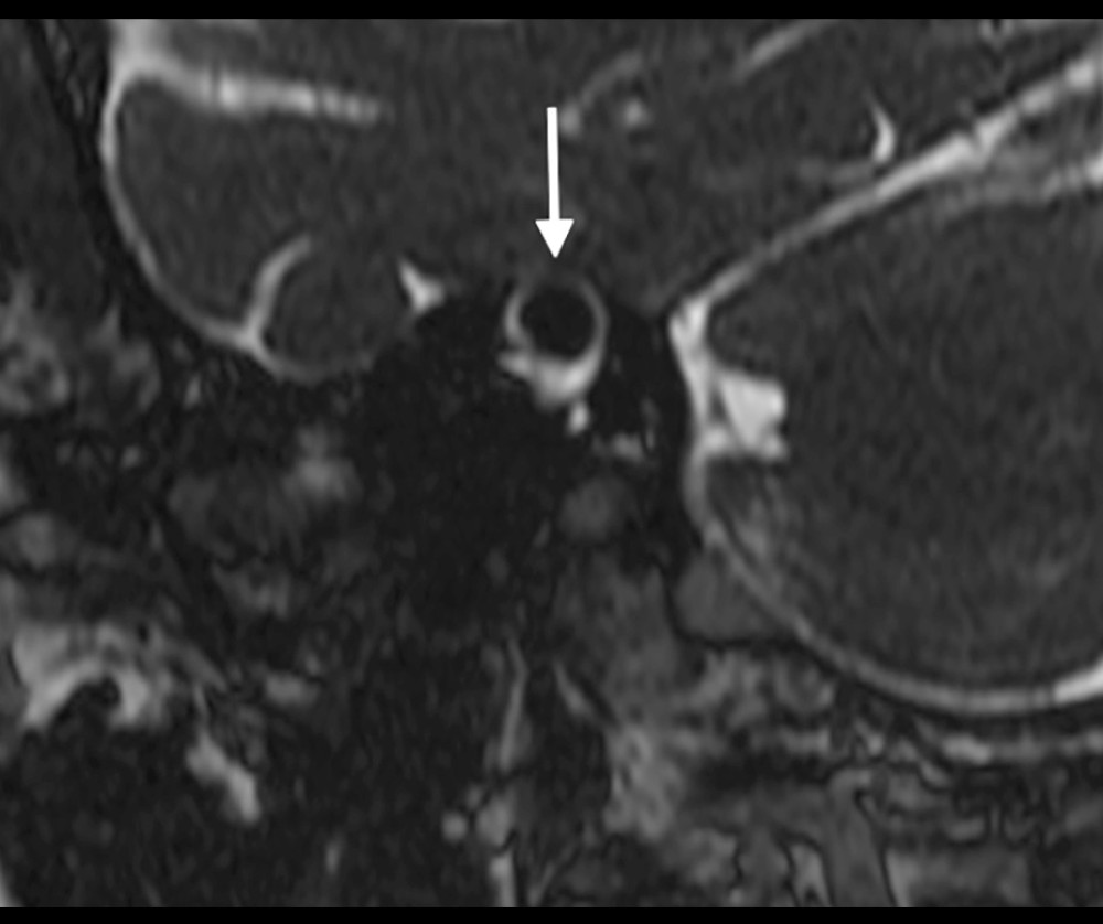 T2-weighted high-resolution fast-field echo MRI of the temporal bone in the sagittal plain. Image shows questionable thinning of the osseous coverage of the right superior semicircular canal (white arrow), compatible with right superior semicircular canal dehiscence.