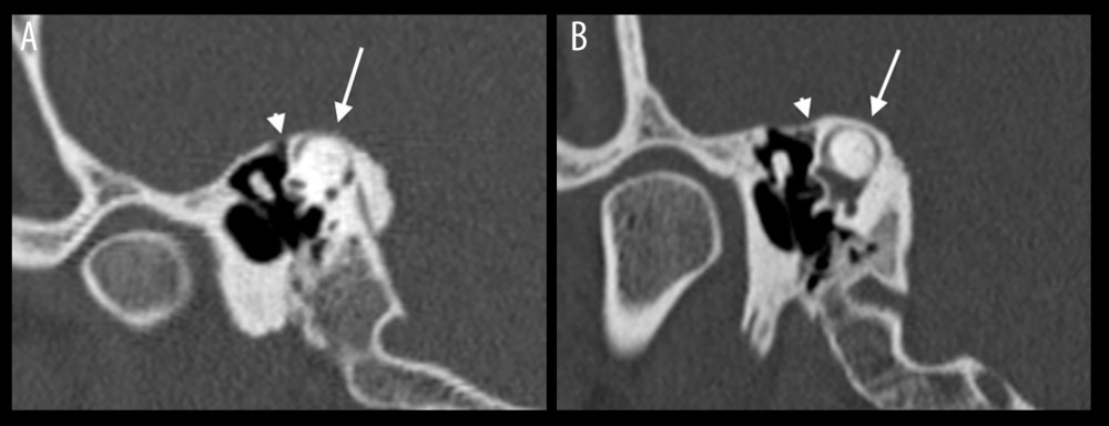 High-resolution temporal bone CT without IV contrast in the Pöschl projection. (A) Segmental dehiscence of the right superior semicircular canal (arrow) and segmental dehiscence of the adjacent portion of the right tegmen tympani (arrowhead). (B) Normal configuration of both the left SSC (arrow) and left tegmen tympani (arrowhead), both demonstrating adequate osseus coverage. Note that the anterior and posterior limbs of the superior semicircular canals appear to have normal caliber and are symmetric, measuring between 1.0 and 1.2 mm in diameter.