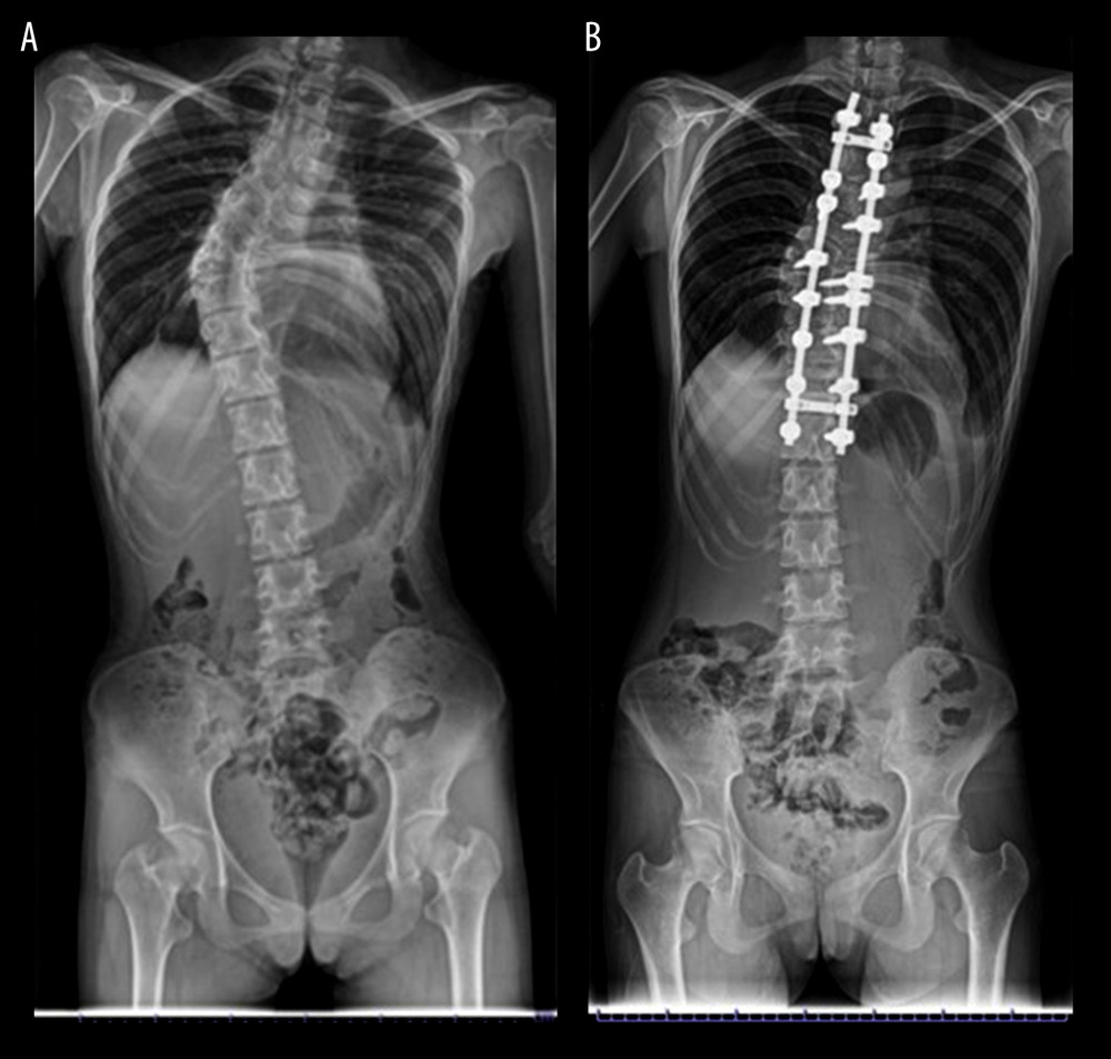 (A) Preoperative radiograph of the spine, (B) Postoperative radiograph of the corrected alignment of spine.