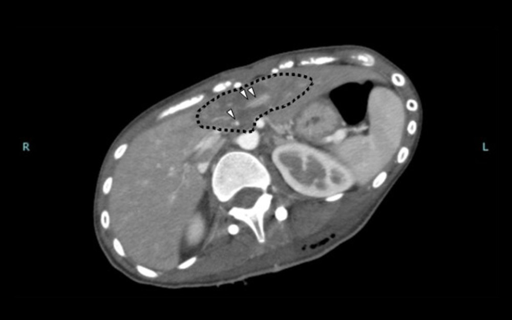 Contrast-enhanced computed tomography on postoperative day 1. …. – poor contrast area in the liver; Δ – contrast-enhanced hepatic artery and portal vein.