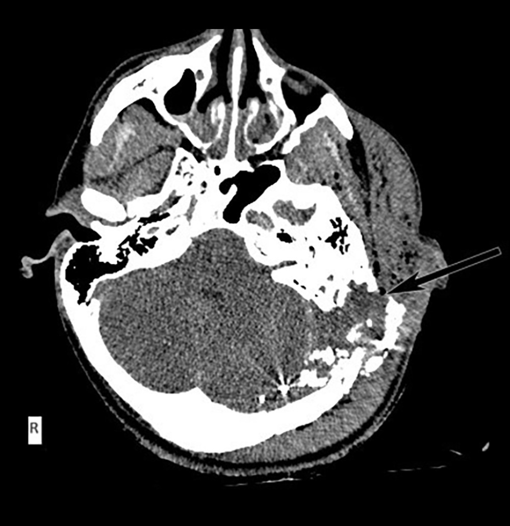 Acute-phase axial computed tomography scan. The arrow indicates the entry point of the bullet, which caused fragmentation of the left temporal bone (petrosal part) and part of the occipital bone. The presence of cerebral fragments, edema, and diffuse contusions can be identified.
