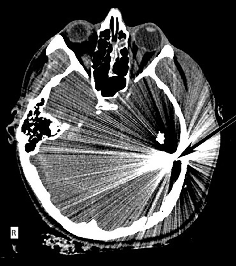 Acute-phase axial computed tomography scan. The arrow points to the projectile inside the temporal lobe parenchyma, above its entry point.