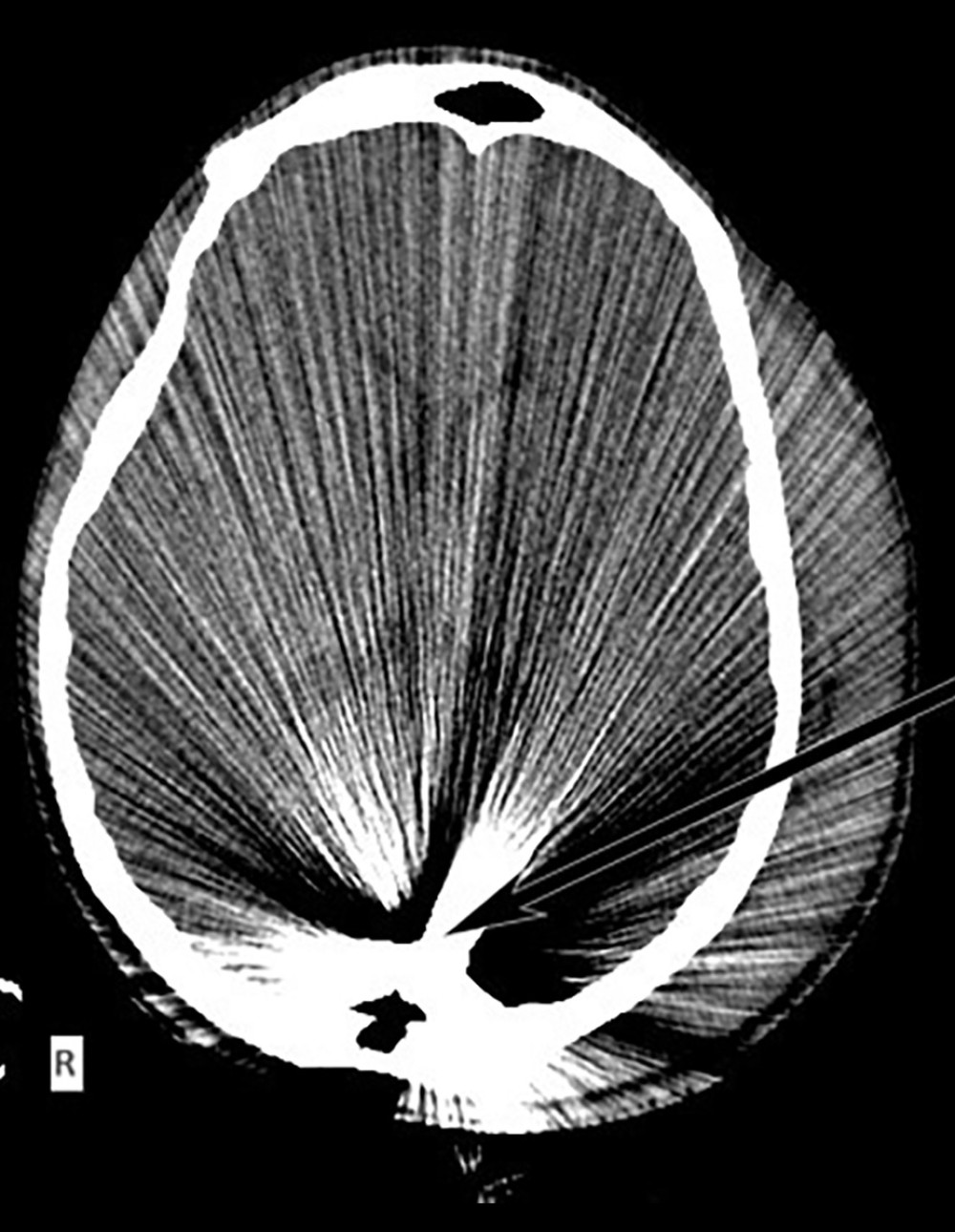 Acute-phase axial computed tomography scan. The arrow points to the central mass of the bullet in the occipital lobe, with no exit found.