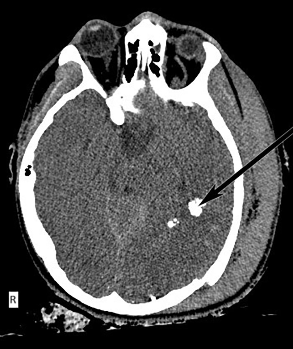 Acute-phase axial computed tomography scan.Cerebral edema and diffuse contusions are recognized. The arrow points to bony fragments along the path of the bullet.