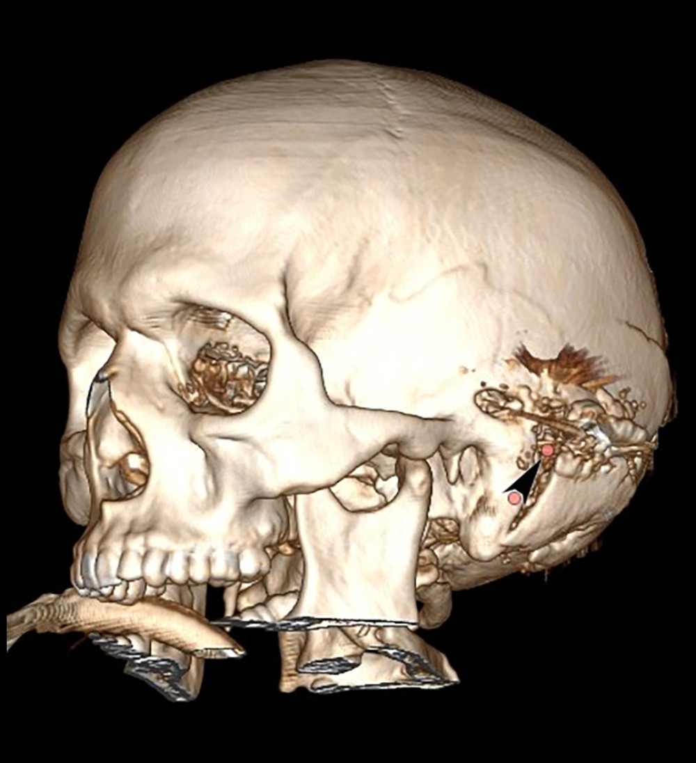Three-dimensional reconstruction of the acute-phase computed tomography scan. Anterio-lateral view of the left side of the cranium: the entry point is shown by the arrow head.
