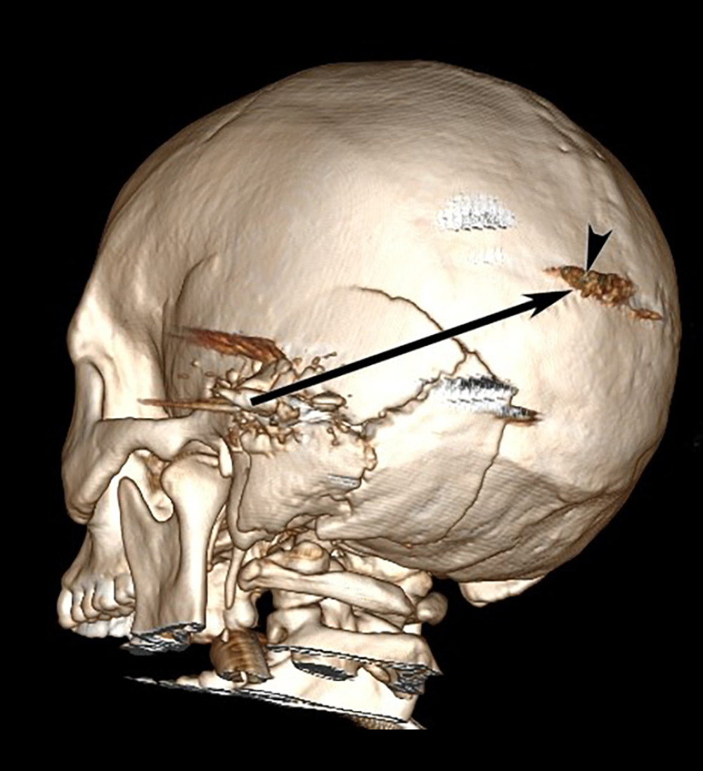 Three-dimensional reconstruction of the acute-phase computed tomography scan. Posterio-lateral view of the left side of the cranium: the trajectory of the bullet from the outside of the cranium is represented here with the arrow. The arrow head points artifacts and not exit point.