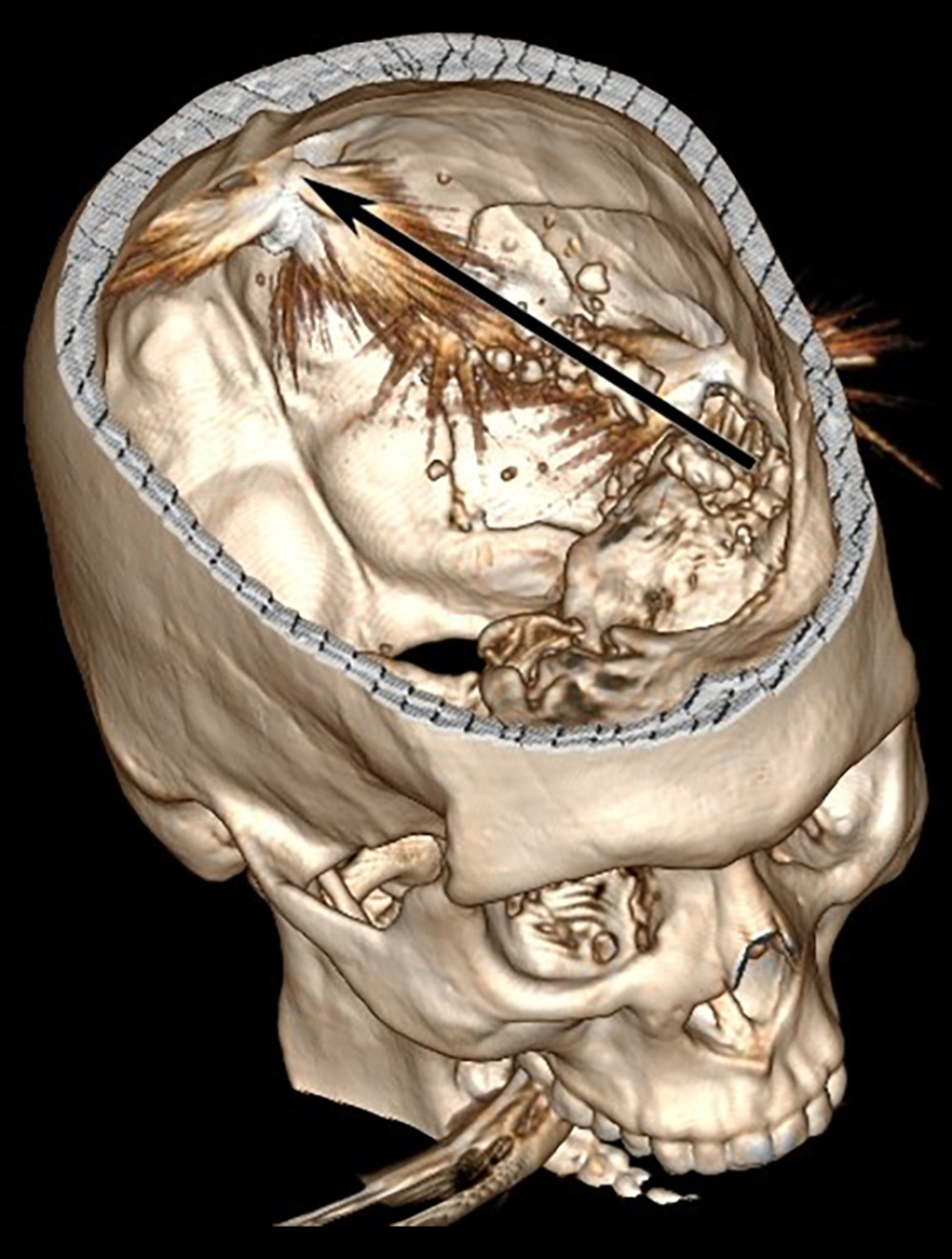 Three-dimensional reconstruction of the acute-phase computed tomography scan. Internal view of the entry point and projectiles’ location. The arrow represents the trajectory of the bullet.