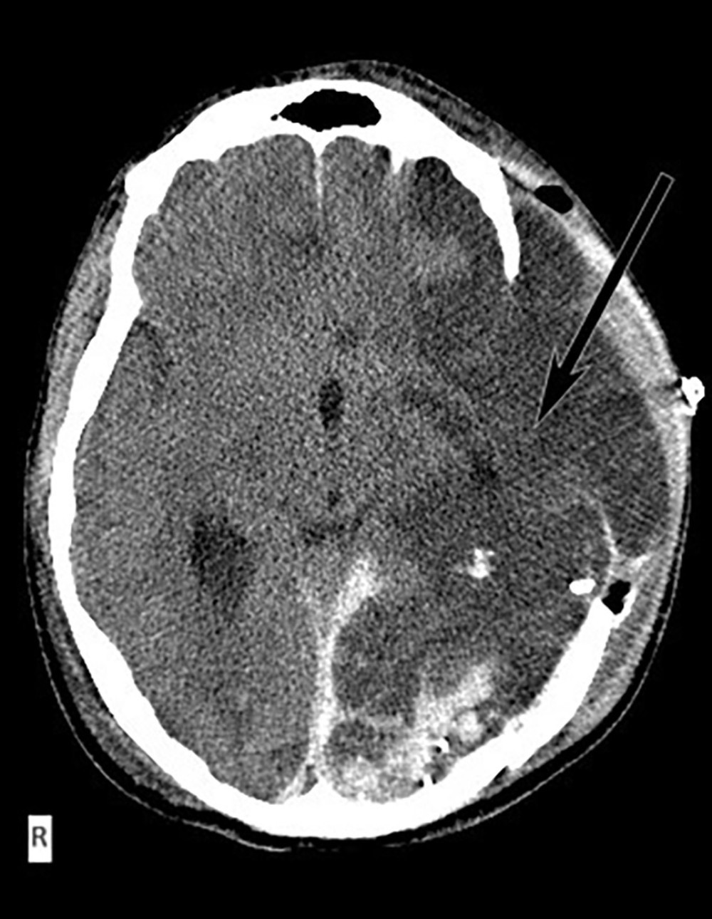 Postoperative axial computed tomography scan. Postoperative findings after left decompressive craniectomy, extensive cerebral edema of the left hemisphere (pointed with arrow). At the occipital lobe, we can recognize traumatic subarachnoid hemorrhage, contusions, and osseus fragments and parafalcine subdural hematoma on the occipital part of the falx cerebri.