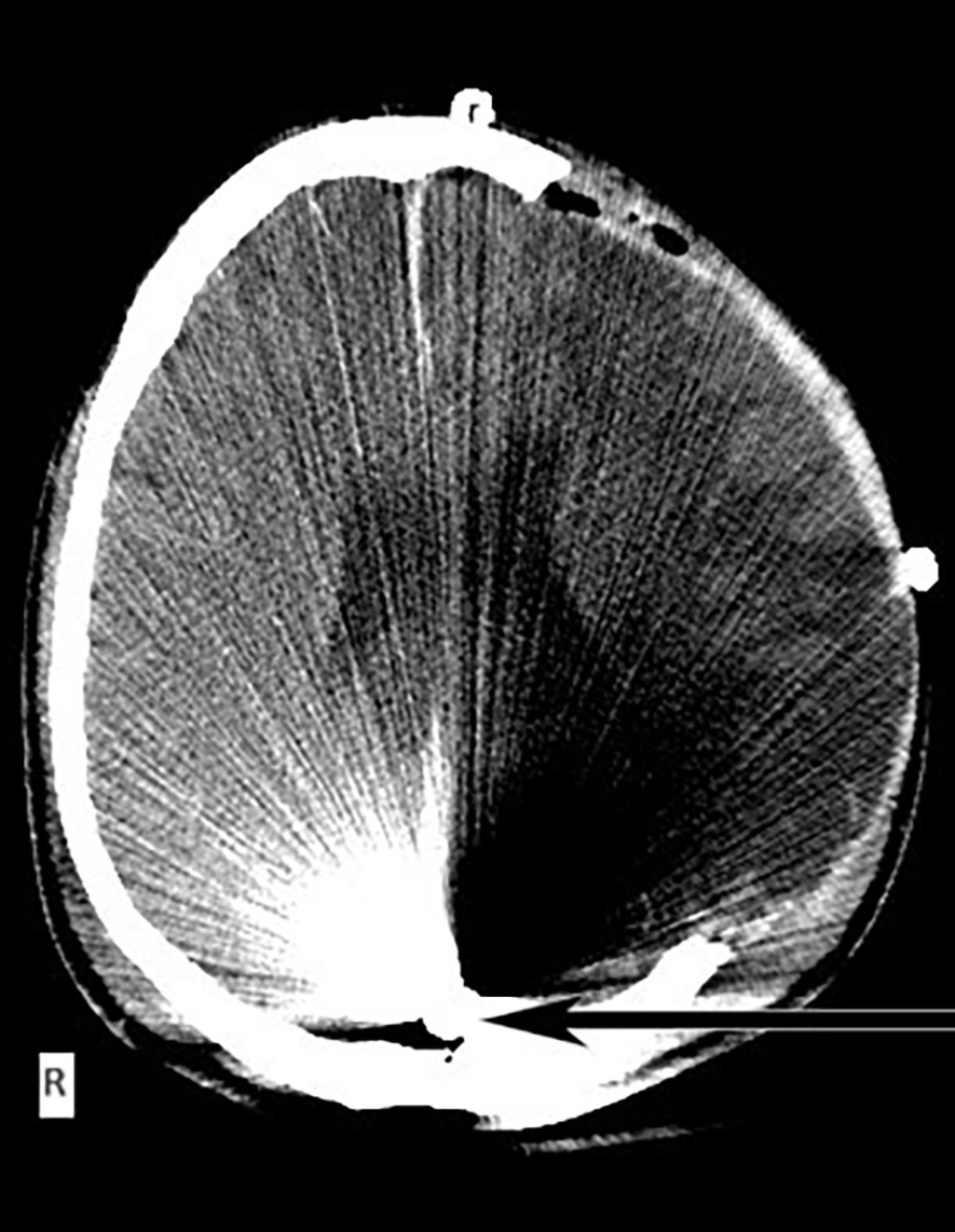 Postoperative axial computed tomography scan. Postoperative findings after left decompressive craniectomy, extensive cerebral edema of the left hemisphere. The projectile that was previously mentioned can be identified at the occipital lobe, as it was not extracted, pointed by the arrow.