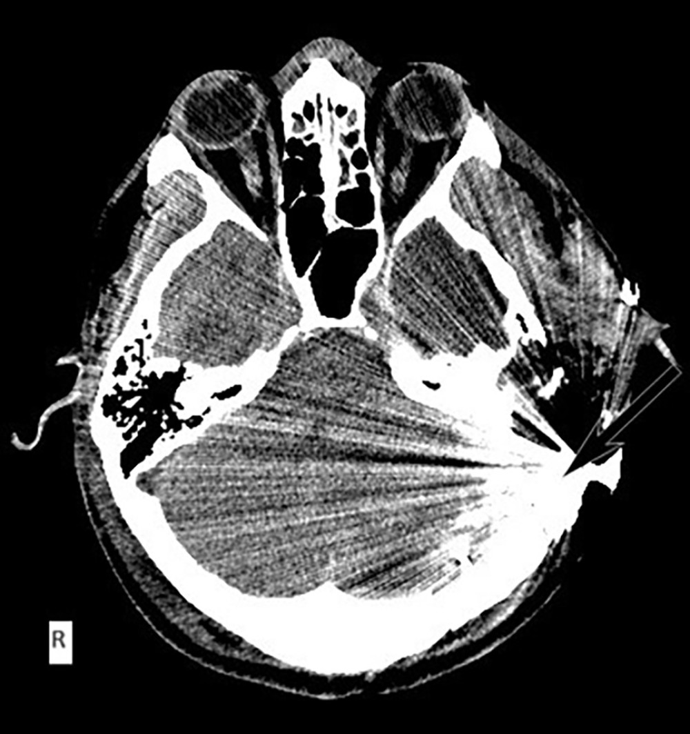 Postoperative axial computed tomography scan. Postoperative findings after left decompressive craniectomy, extensive cerebral edema of the left hemisphere. At the temporal lobe, we can recognize another projectile that was previously mentioned, as it was not removed, pointed by the arrow.