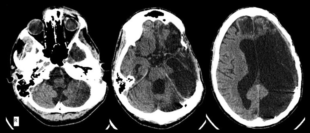 Axial computed tomography scan obtained at 2.5 months after injury, after performing cranioplasty, revealing extensive gliosis of the left cerebral hemisphere, encroaching into the ipsilateral cerebellar hemisphere, and distention of the ventricular system.