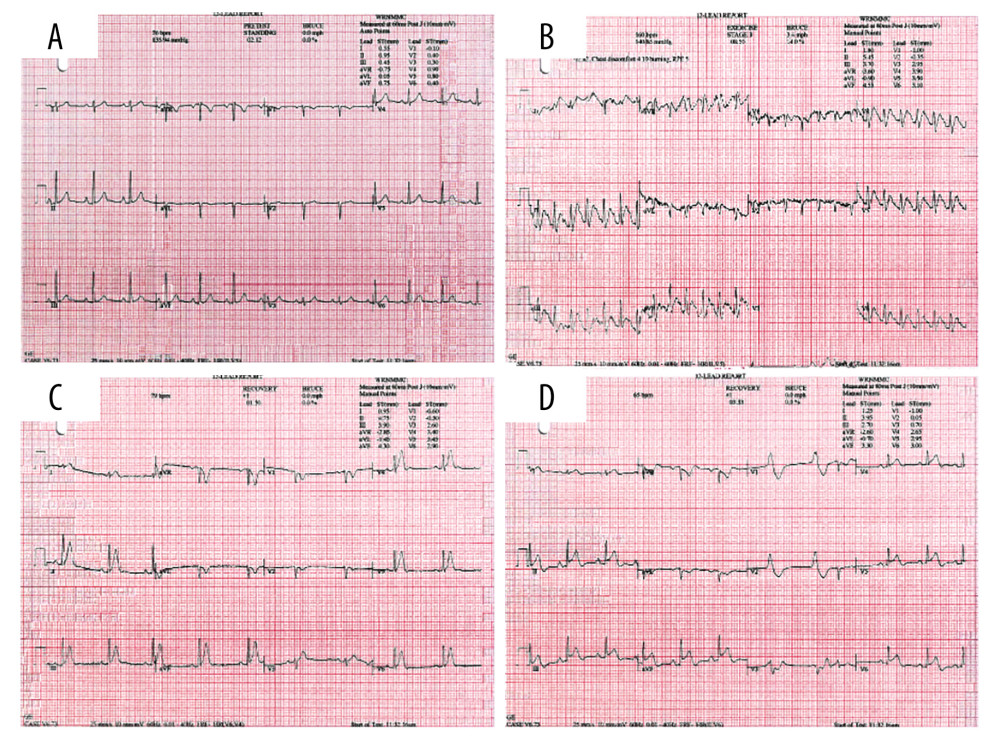 GXT ECG progression. (A) Resting ECG demonstrating normal sinus rhythm with baseline nonspecific ST abnormalities most consistent with early repolarization. (B) ECG tracing at the onset of chest pain. Hyperacute T waves are seen. (C) ECG during recovery with persistent hyperacute T waves. (D) ECG tracing later in recovery with ST segment elevations in the inferior and lateral leads. Two ventricular beats are seen, likely paroxysmal accelerated idioventricular rhythm.