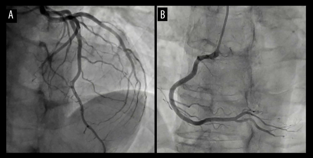 Coronary angiogram: Assessing coronary artery patency. (A) Caudal projection demonstrating a normal left coronary system without irregularities. (B) Anteroposterior projection demonstrating a normal right coronary system without irregularities.