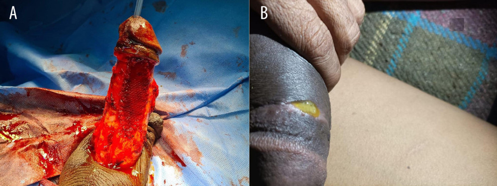 (A) Intraoperative picture shows graft placement. (B) Penile prosthesis wound infection.