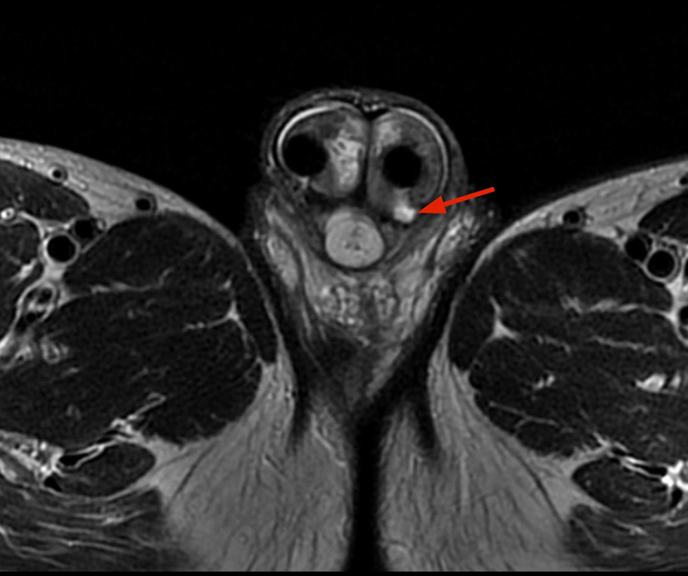 Penile MRI shows 14×7 millimeters loculated fluid collection in the left corpora cavernosum.