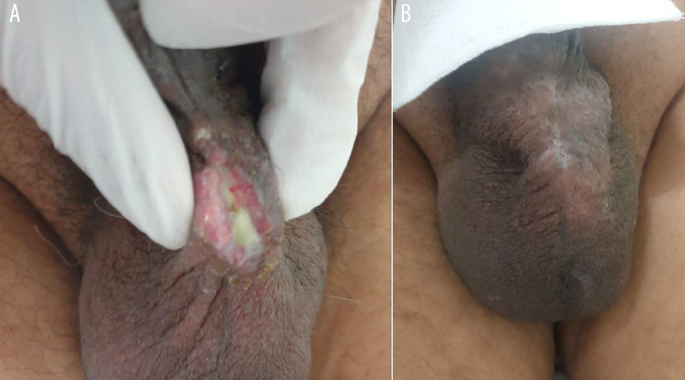 (A, B) Surgical site of case 2 wound before and after conservative management.
