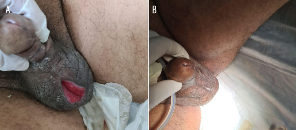 (A, B) Surgical site wound of case 3 before and after conservative management.