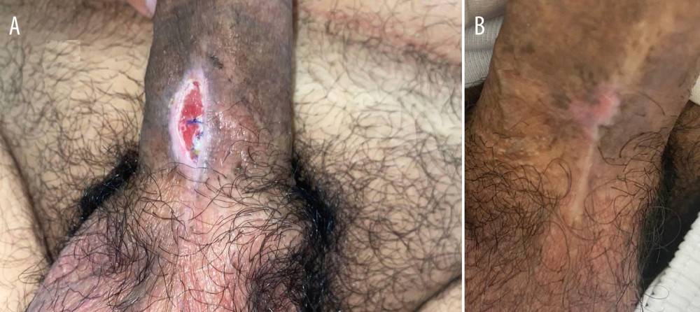 (A, B) Surgical site wound of case 4 before and after conservative management.