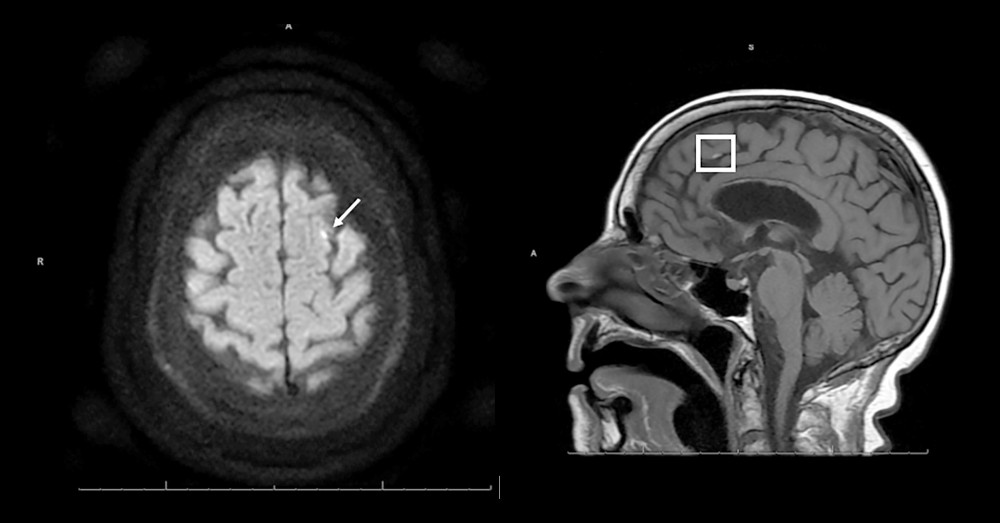 Magnetic resonance imaging of the brain via diffusion-weighted imaging on the axial view (top image) and fluid-attenuated inversion recovery via the sagittal view (bottom image) revealed a punctate acute left superior frontal gyrus cortical infarct.