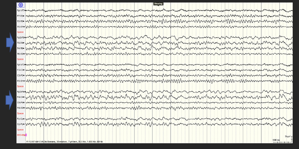 Electroencephalogram revealed a focal, intermittent, slowing of the right anterior hemisphere, involving the frontocentral and frontotemporal regions, without clear seizures or epileptiform discharges (highlighted via blue arrows).