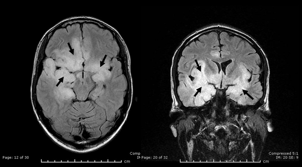 Brain MRI of a 21-year-old man with severe HSV-1 encephalitis showing bilateral, primarily cortically based, asymmetric edema with underlying restricted diffusion involving the frontal lobes, insula, and temporal lobes, right greater than left, with relative sparing of the basal ganglia. Arrows point to some areas of involvement. MRI, magnetic resonance imaging; HSV-1, herpes simplex virus 1.