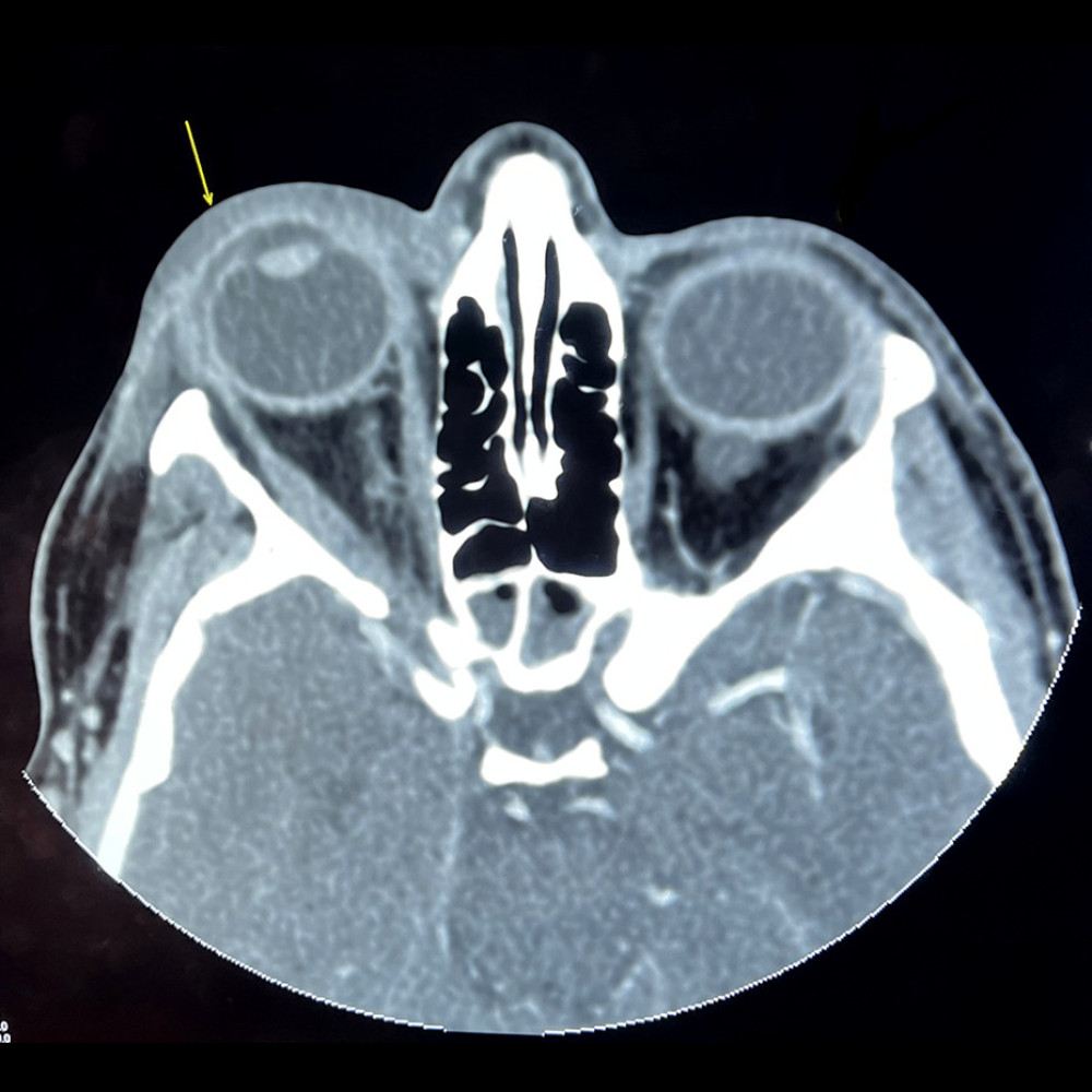 Axial orbital computerized tomography. The arrow shows right pre-septal diffuse thickening with edematous changes and non-homogenous enhancement as well as marginally enhancing collection along the antero-lateral aspect of the globe.