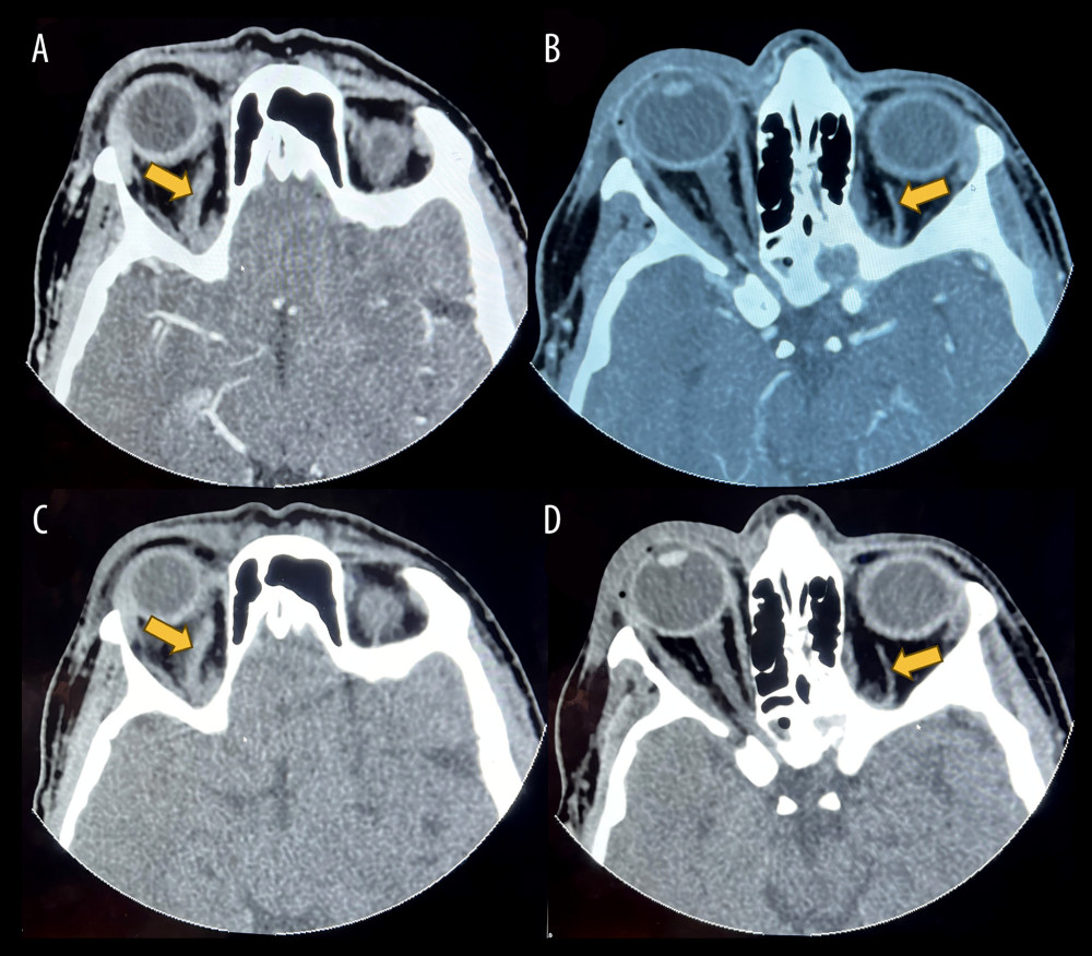 (A) Post-contrast axial orbital computerized tomography (CT) and (C) pre-contrast CT: the arrows show prominent and nonhomogenously enhancing right superior ophthalmic vein, indicating thrombosis. (B) Post-contrast orbital CT and (D) pre-contrast CT: the arrows show average caliber homogenously enhancing left superior ophthalmic vein.