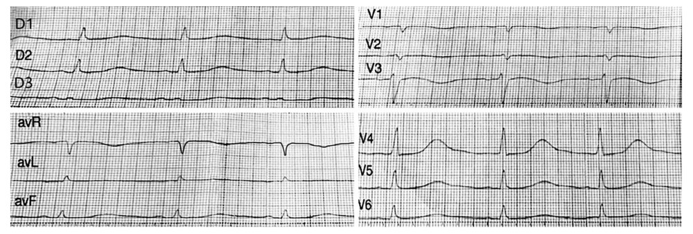 Post-cardiac arrest 12-lead electrocardiogram. Rhythm: sinus rhythm with a left bundle branch block. Heart rate: 42 beats/ minute. PR interval: 240 ms. QRS: 120 ms. Q-T interval: 840 ms. Corrected QT (QTc): 710 ms.