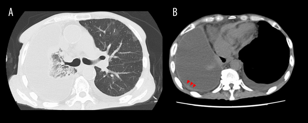 Chest computed tomography (CT) on admission. Chest CT revealed pleural effusion and consolidation in the right lung (A) and pleural effusion with pleural thickening (B, red arrow heads).