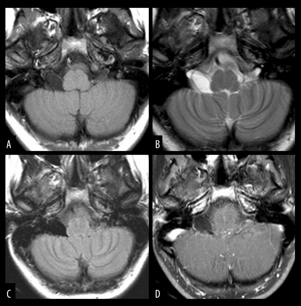 Axial magnetic resonance images illustrating multiple sequences, including T1-weighted (A), T2-weighted (B), FLAIR (C), and post-contrast T1 sequences (D). These images reveal an extra-axial lesion located in the right cerebellopontine angle with signal intensity closely resembling that of cerebrospinal fluid, suggesting a diagnosis of an arachnoid cyst.