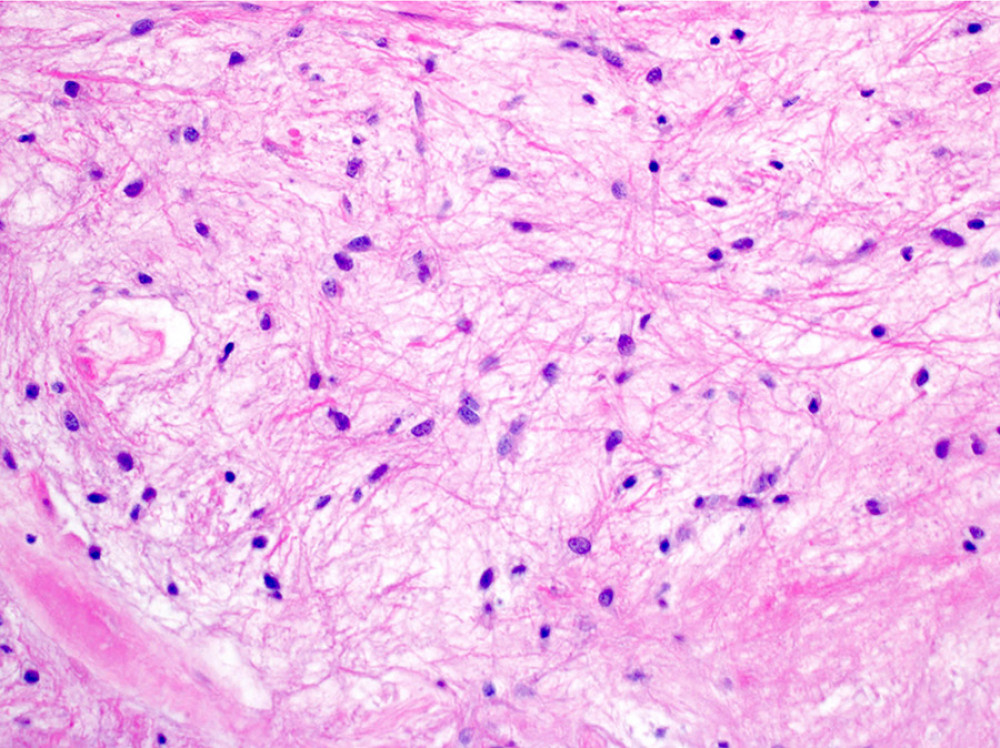 Histopathological micrograph displaying the defining biphasic pattern in pilocytic astrocytoma, with elongated spindle-shaped cells and piloid cells bearing hair-like processes.