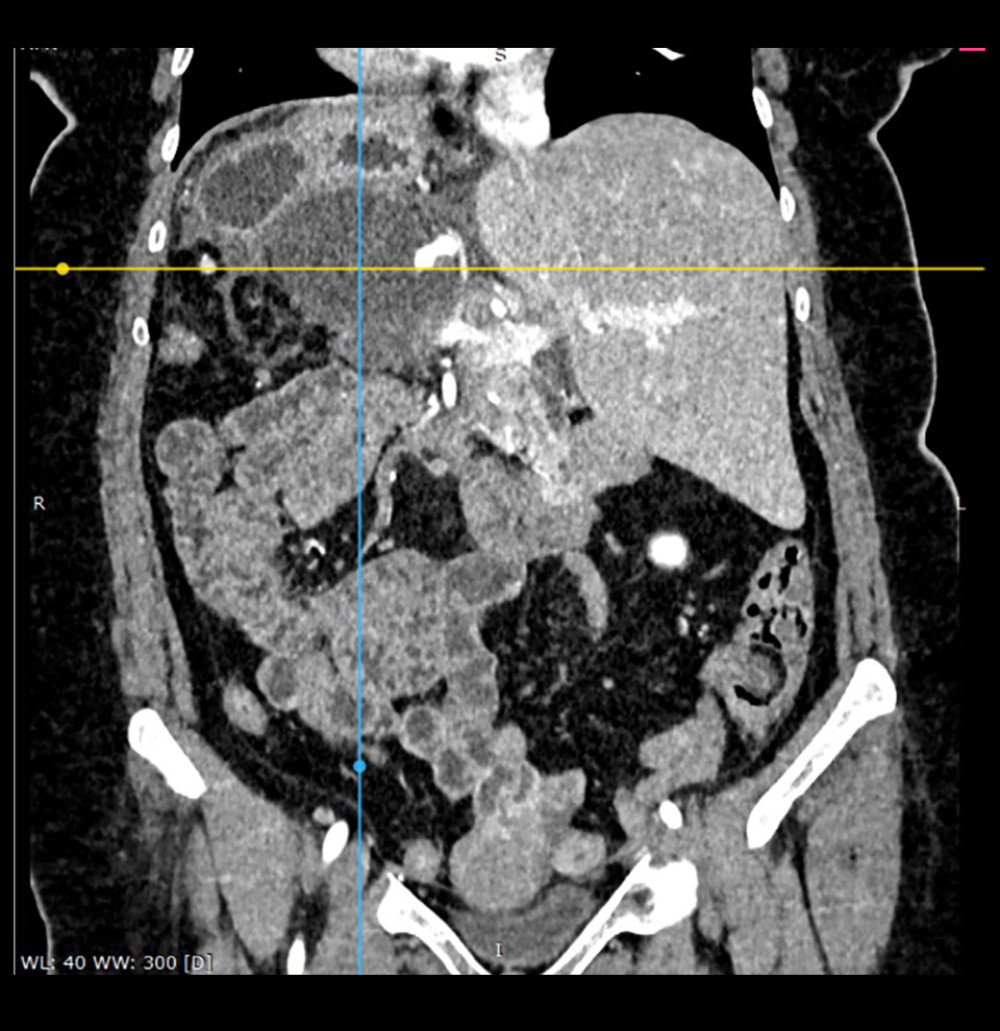 CT of the abdomen. Pancreatic pseudocyst indicated by intersecting horizontal and vertical, colored lines. Situs inversus totalis was noted.