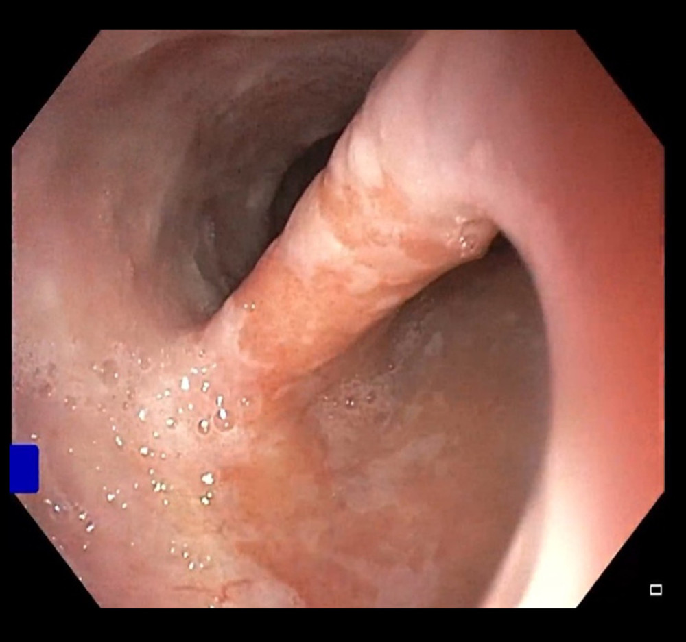 Endoscopic image of the bifurcation of the esophagus.