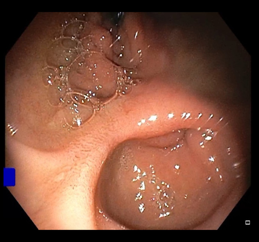 Endoscopic image of bulbar portions of both duodenums.