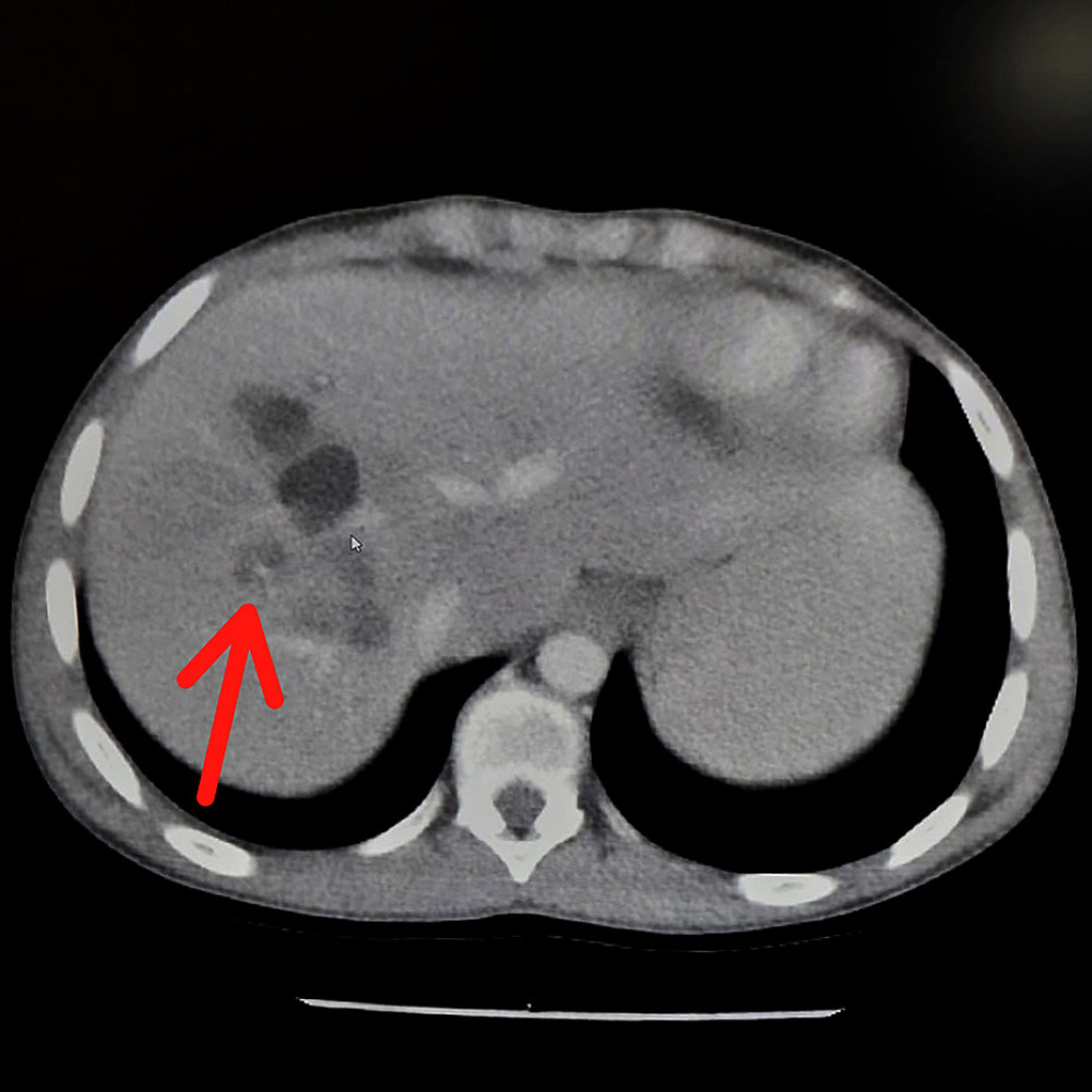 Contrast-enhanced computerized tomography scan. The picture shows dilated intrahepatic ducts (hypodense regions on the right lobe of the liver). The red arrow points to the central dot sign, which is a hypodense (dark) region that has a white color within it, corresponding to contrast within the portal vein, which is surrounded by a dilated intrahepatic duct. Plane of view: axial plane.