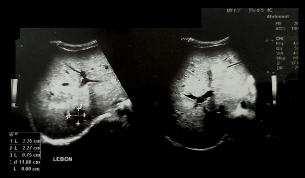 Ultrasound scan. The picture shows dilated intrahepatic ducts (the large hypointense regions within the liver), one at the top and the other at the bottom of the picture. Plane of view: transverse plane.