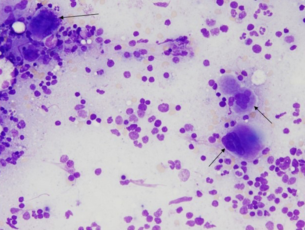 Bone marrow aspirate with Wright-Giemsa stain, 20×, showing 3 dysmorphic megakaryocytes as indicated by the arrows.