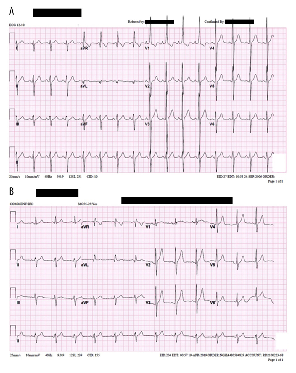 (A) An initial electrocardiogram (ECG) highlighting a ventricular rate of 92 beats per minute (BPM), a PR interval of 152 milliseconds (ms), a QRS duration of 106 ms, a QT/QTc interval of 360/445 ms, and P-R-T axes at 68, 236, and 61 degrees, respectively. (B) A post-treatment ECG demonstrating a ventricular rate of 77 BPM, a PR interval of 136 ms, a QRS duration of 104 ms, a QT/QTc interval of 368/416 ms, and a corrected P-R-T axis, reflecting the normalization of post-intervention cardiac electrical activity.