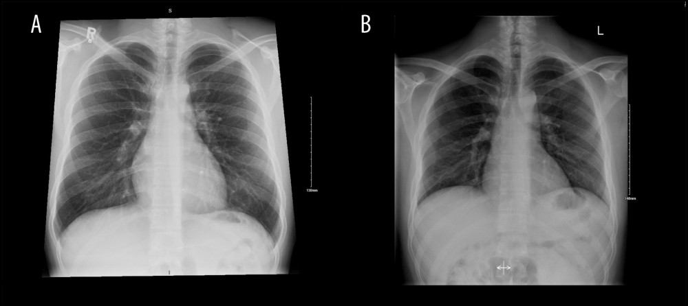 Comparative chest X-rays (A) before and (B) after intervention.
