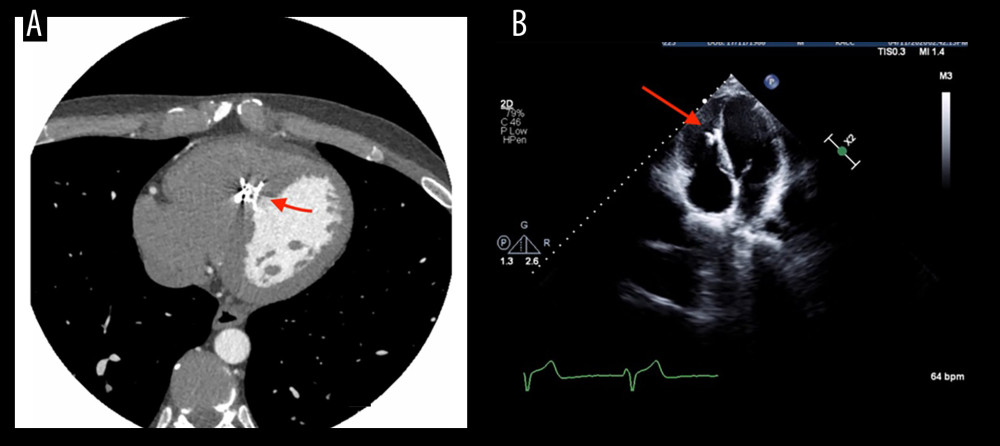 (A) An image displaying the precisely positioned ventricular septal defect (VSD) closure device within the mid-septum. Notably, there are no signs of coronary artery stenosis or severe atherosclerotic plaque, highlighting the accuracy and safety of the procedure. (B) A close-up view of the VSD closure device (marked by the bright area and indicated by an arrow), validating the successful post-procedure deployment and correct positioning of the device.