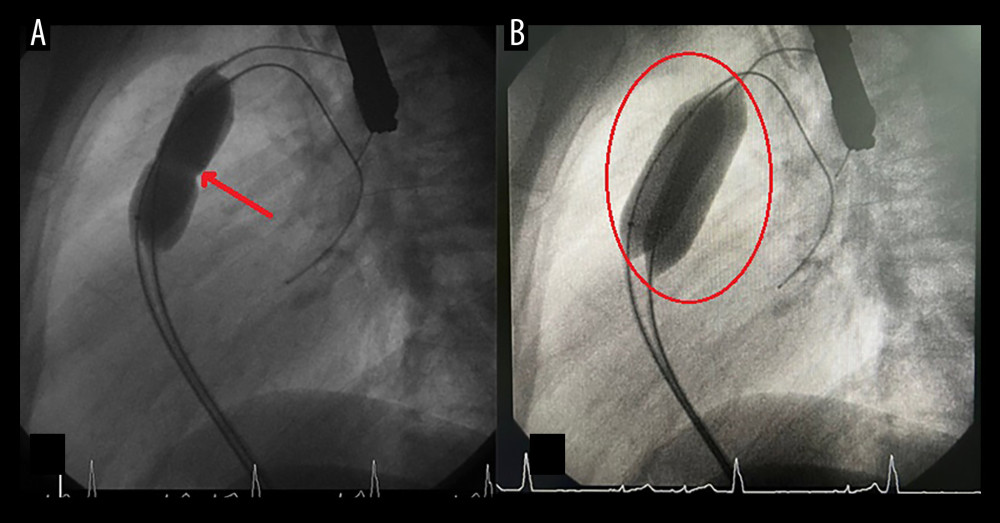 Lateral cineangiograms during balloon valvuloplasty for pulmonary valve stenosis. Panel A shows the inflated balloon catheter positioned across the pulmonary valve with a mid-balloon waist (indicated by the red arrow), reflecting the stenotic region. Panel B shows the successful dilation of the pulmonary valve, with the balloon fully inflated and no residual waist (outlined in red), indicating the absence of stenosis. The procedure resulted in a significant drop in transvalvular pressure, confirming the effectiveness of the valvuloplasty.